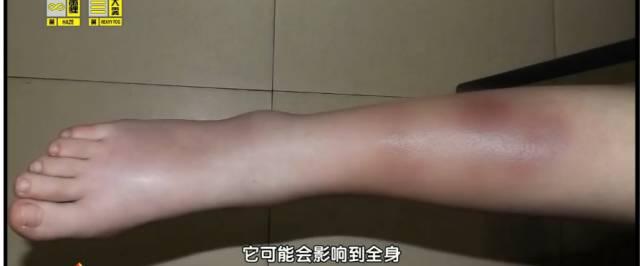 女孩作息黑白颠倒小腿长满紫红色斑